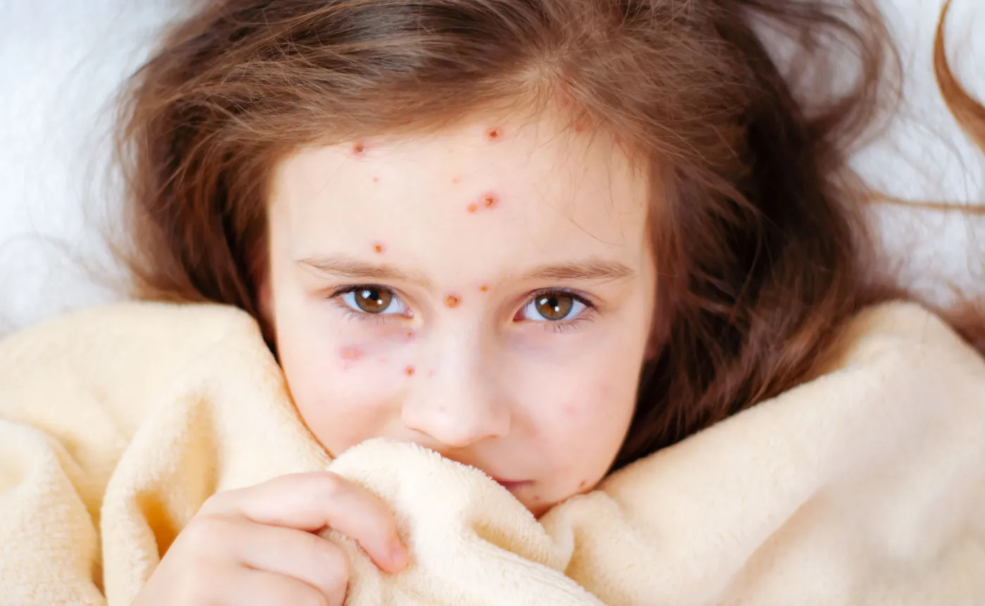Pediatra: W tym sezonie dużo więcej dzieci z powikłaniami ospy