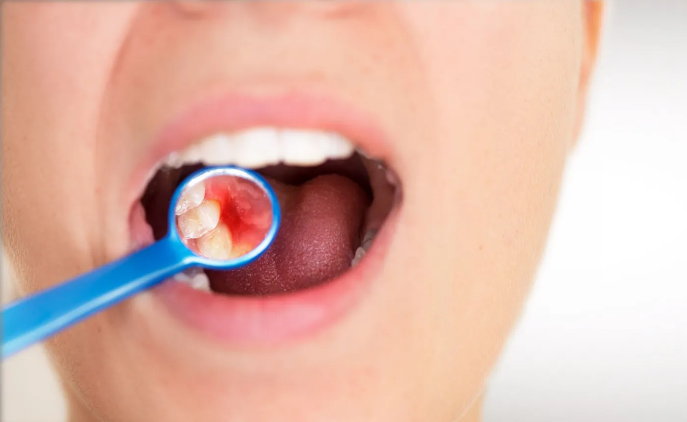 5 mało znanych przyczyn przebarwień zębów i jak je usunąć