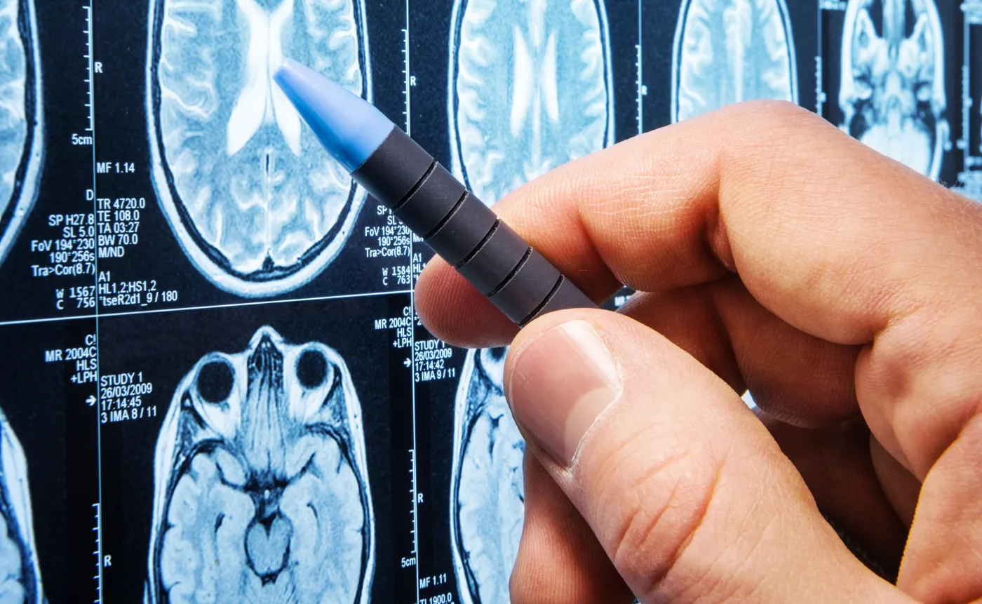 Nowa bardziej skuteczna metoda leczenia glejaka opracowana przez polskich specjalistów