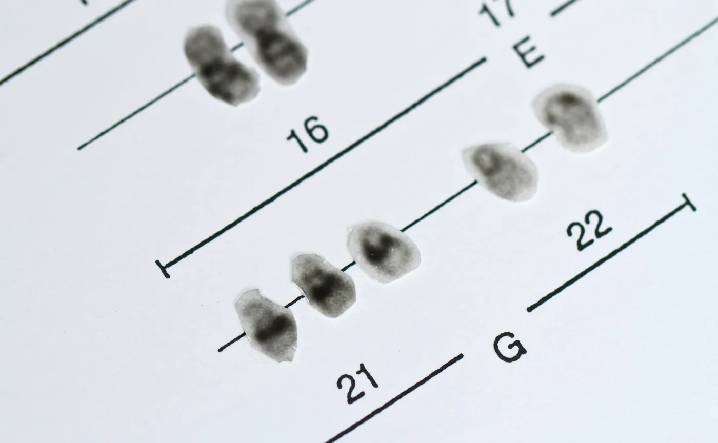 W Polsce żyje 60 tys. osób z zespołem Downa, ponad 70 proc. z nich dożywa ponad 50 lat