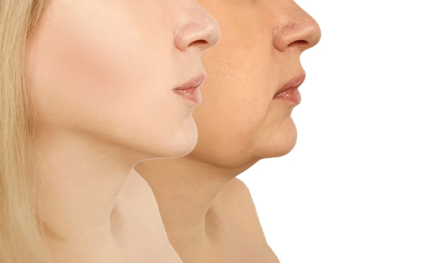 Odmładzanie bez bólu. Na czym polega mezoterapia próżniowa?