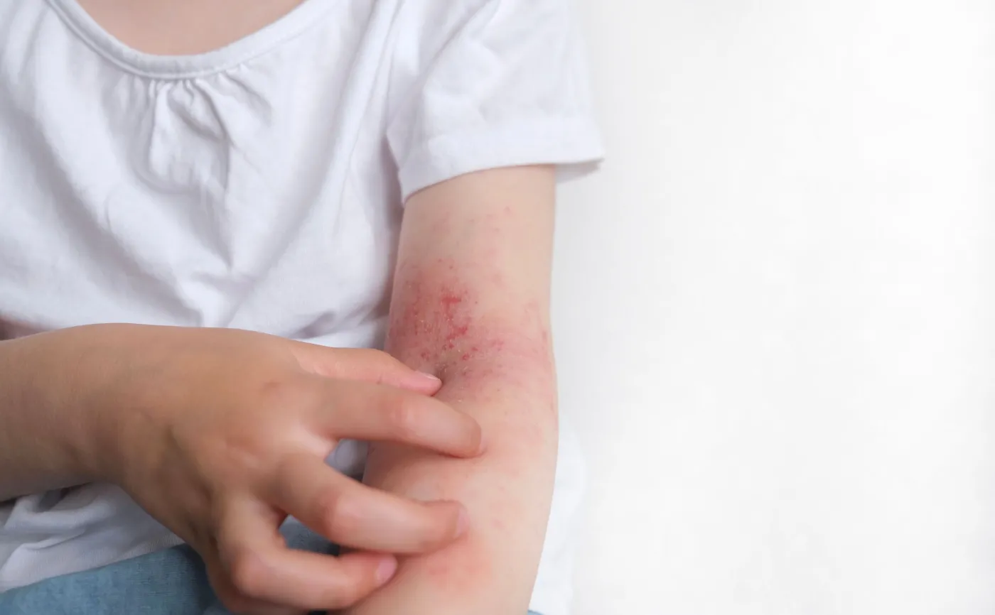 Coraz więcej dzieci ma alergię na antybiotyki. OBJAWY. Jak to zatrzymać?