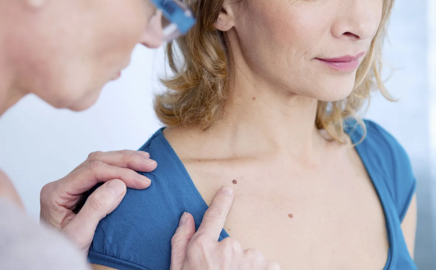 Co robić, aby latem nie nabawić się przebarwień