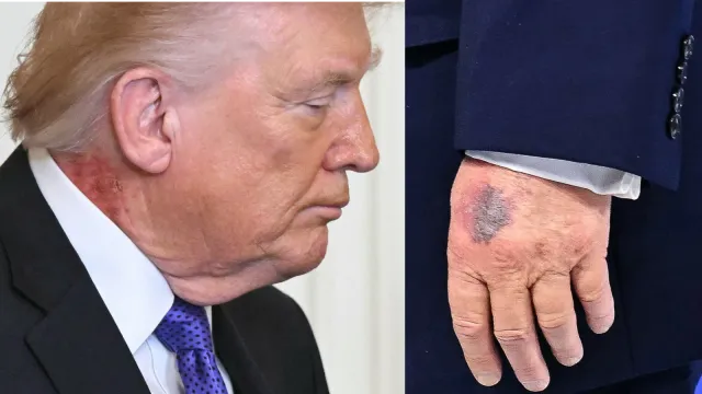 Coś się dzieje ze zdrowiem Donalda Trumpa. Nowe duże, czerwone plamy. Lekarz tłumaczy