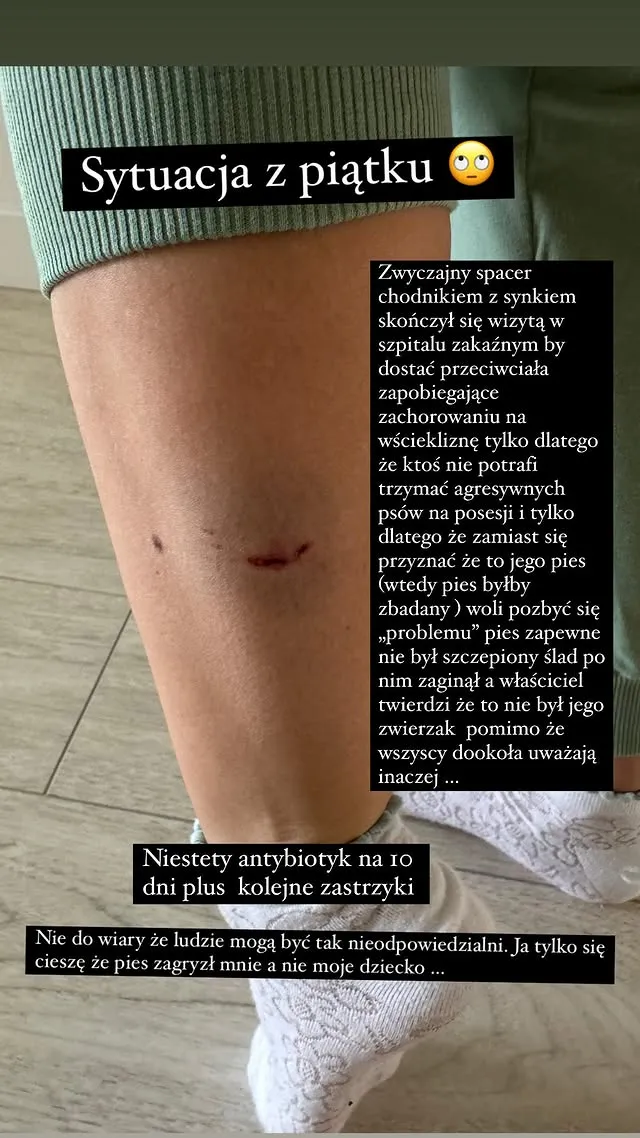 gwiazda-zespolu-disco-polo-pokazala-w-sieci-noge-pogryziona-przez-psa-38433791.jpg