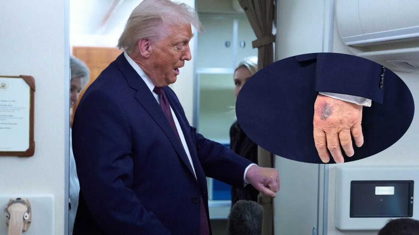 Stan zdrowia Donalda Trumpa budzi niepokój. Powraca potężny siniak na dłoni