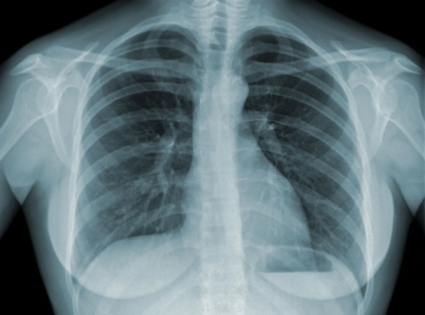 Krztusiec, gruźlica, błonica. Prof. Czauderna: W Polsce mogą się pojawić choroby, które od dawna nie występowały