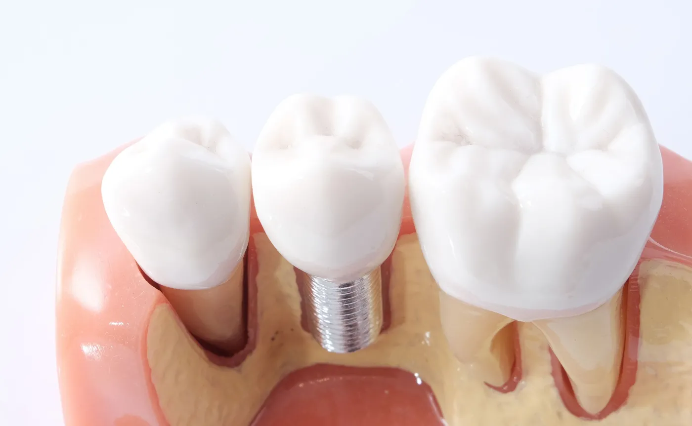 Hodowla implantów w gabinecie dentystycznym? Teraz jest to już możliwe