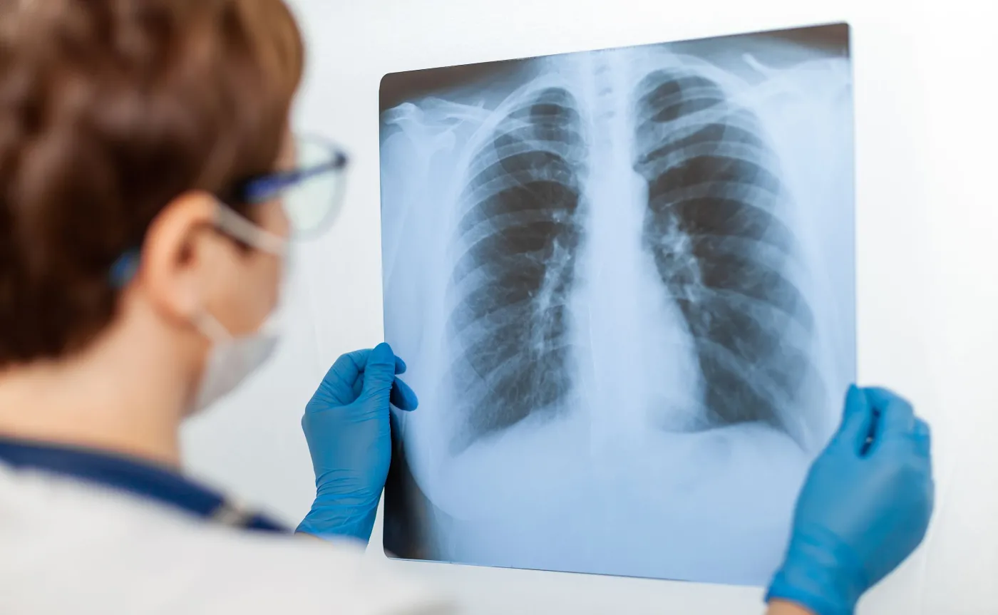 Idiopatyczne włóknienie płuc u 22 proc. pacjentów z ciężkim przebiegiem COVID-19