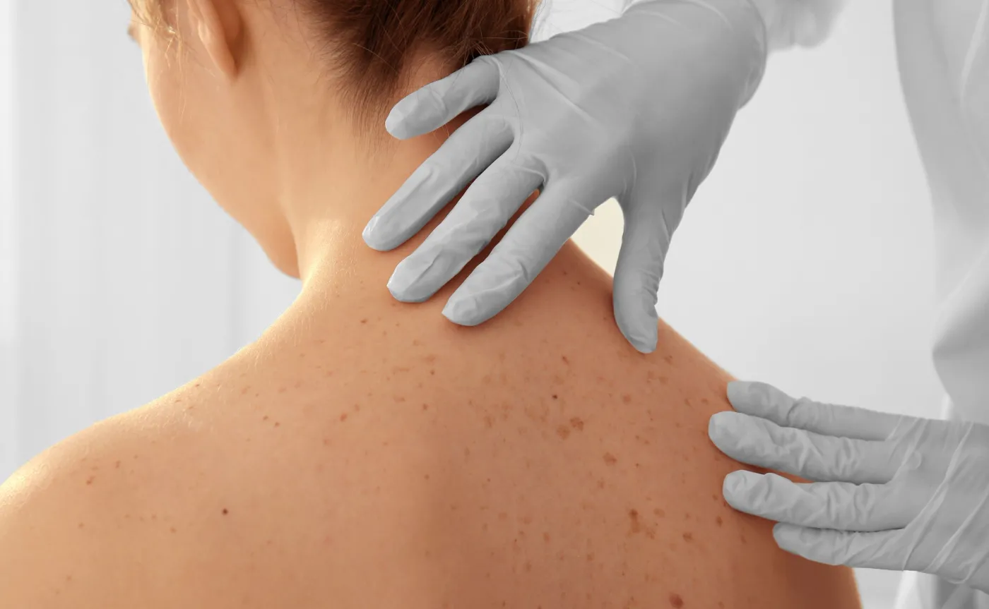 Dermatolodzy: u 20 proc. chorych na Covid-19 pojawiają się zmiany na skórze