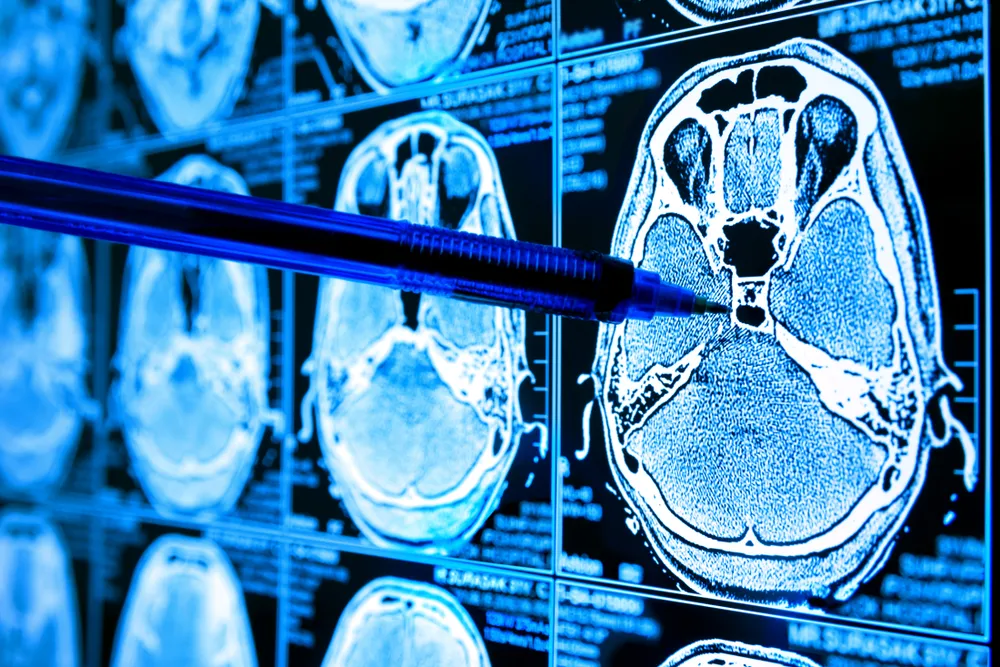 Sztuczna inteligencja może wprowadzać w błąd radiologów