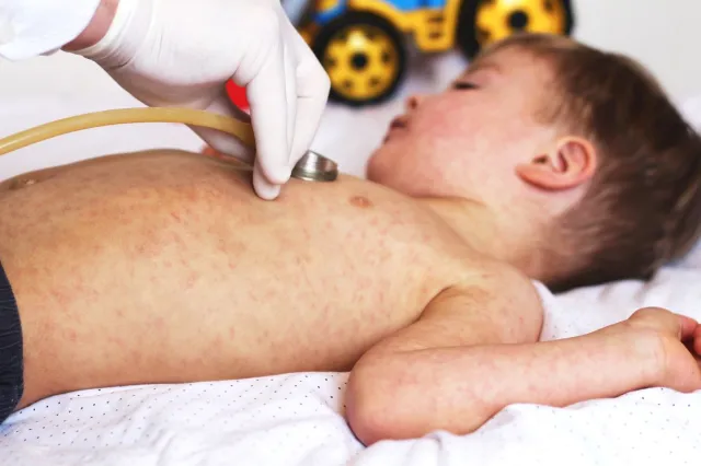 Odra w Polsce: rośnie liczba zachorowań na Podkarpaciu